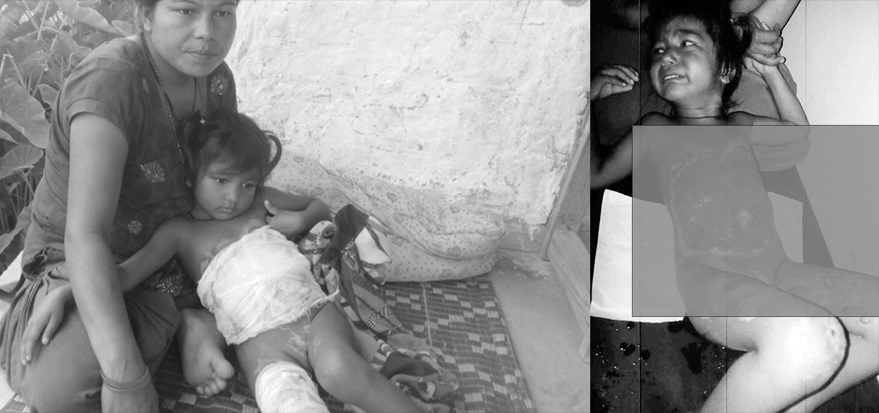 आगोले पोलेर गम्भिर ५ वर्षिय बालिकाको उपचारमा सहयोगको आग्रह