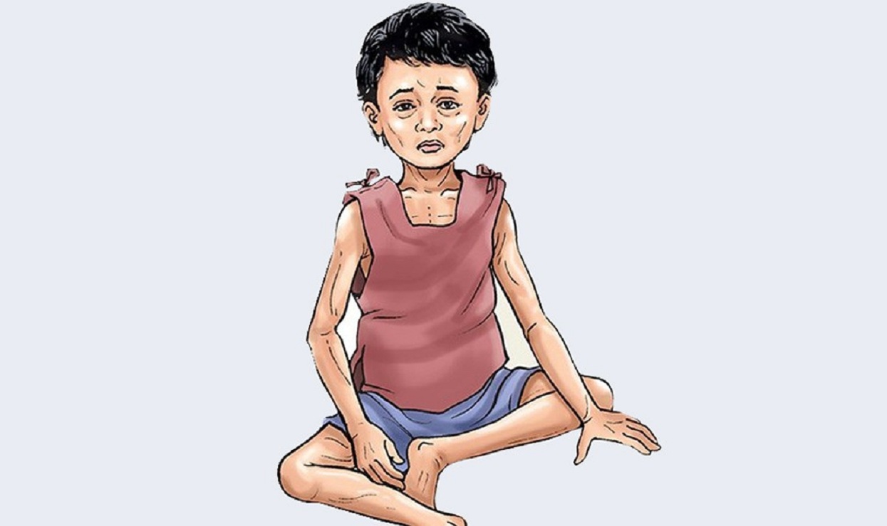 सामाजिक बहिस्करणको त्रासले लुकाइन्छ कुपोषण