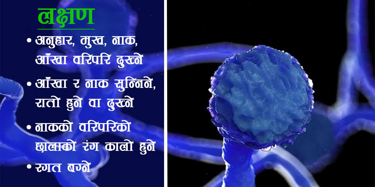 नेपालमा १० जनामा भेटियो ‘कालो ढुसी’, कसरी चिन्ने, कसरी बच्ने ?