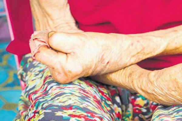 कुष्ठरोगको ‘रेड जोन’मा बाँके