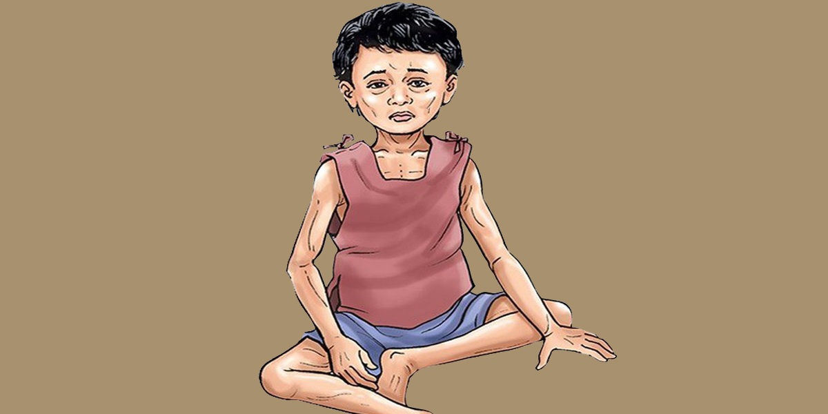 मधेसका १६ प्रतिशत बालबालिकामा कुपोषण