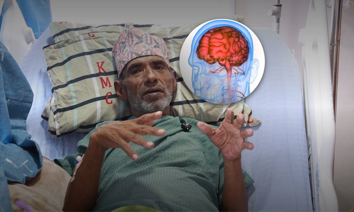 केएमसीमा ६७ वर्षीय वृद्धको मस्तिष्कमा भएको जटिल ‘एभीएम’ चिरफारबिनै उपचार